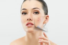 Cách chăm sóc da và trang điểm khi da bị mụn trứng cá 