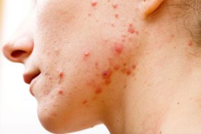 Chăm sóc da mụn: Những việc nên/ không nên làm