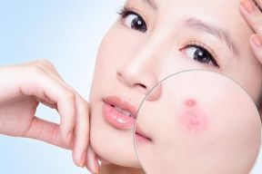 Mụn bọc là gì và tại sao lại khó chữa?