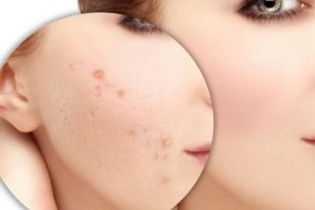 Các bước chăm sóc da mụn thâm