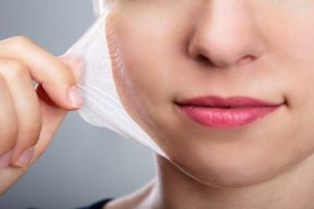 Peel da trị mụn là gì? Có an toàn và hiệu quả không?