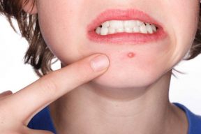 Có nên nặn mụn bọc có mủ không?