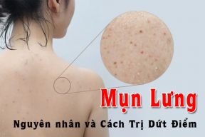 12 cách trị mụn lưng tại nhà hiệu quả giúp bạn lấy lại vẻ gợi cảm quyến rũ