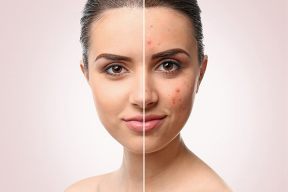 NHỮNG THÀNH PHẦN MỸ PHẨM DA MỤN KHÔNG NÊN SỬ DỤNG