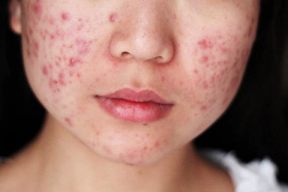 Thực phẩm nào tốt cho da mụn?