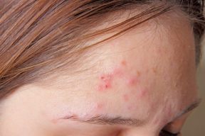 Hướng dẫ bạn cách chăm sóc cho làn da dễ bị mụn trứng cá
