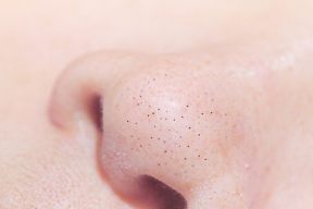 5 CÁCH GIẢM MỤN ĐẦU ĐEN Ở MŨI BẠN KHÔNG THỂ BỎ QUA