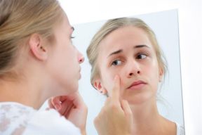 BHA là gì trong mỹ phẩm? Dùng BHA có bị đẩy mụn không?