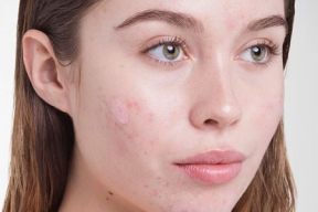 SẢN PHẨM CHO DA MỤN CÓ NÊN CHỨA CHẤT BẢO QUẢN HAY KHÔNG?