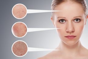 Mách bạn cách trị mụn cám dành cho da nhờn