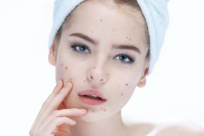 LƯU Ý KHI DÙNG BHA ĐỂ GIẢM MỤN