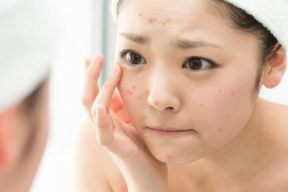 PHÂN LOẠI CÁC LOẠI MỤN VÀ CÁCH KHẮC PHỤC PHÙ HỢP