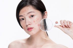 TẠI SAO QUA TUỔI DẬY THÌ MÀ DA VẪN NỔI MỤN