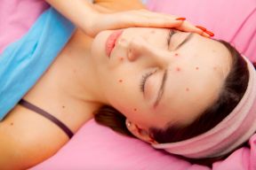 CÁCH CHĂM SÓC DA SAU KHI BỊ THỦY ĐẬU ĐỂ KHÔNG BỊ SẸO