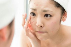 8 Cách trị mụn bọc sưng đỏ an toàn hiệu quả không để lại vết thâm
