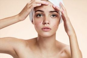 Cách Trị Thâm Đỏ Sau Mụn Và Những Điều Cần Lưu Ý