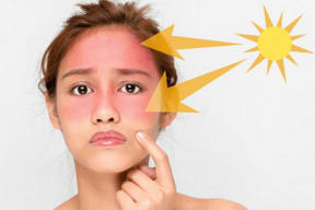 Cấp cứu da cháy nắng ngày Hè vừa nhanh, vừa dễ chỉ với 05 tip này, thử ngay 