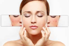 LÝ GIẢI NGUYÊN NHÂN VITAMIN C GÂY KÍCH ỨNG LÀN DA NHẠY CẢM