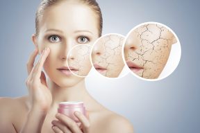MỤN BÙNG NỔ VÌ DA BỘI THỰC DƯỠNG CHẤT