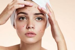 NHỮNG LƯU Ý CHĂM SÓC DA SAU KHI NẶN MỤN