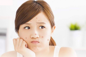 Cách Điều Trị Mụn Ở Tuổi Dậy Thì – Điều Nên Và Không Nên Làm