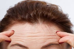 NẾP NHĂN VÙNG TRÁN – CHUYỆN KHÔNG CỦA RIÊNG AI