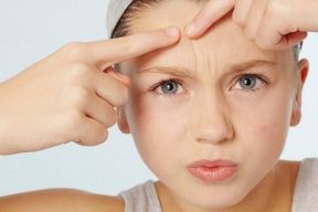MỐI LIÊN HỆ GIỮA STRESS VÀ MỤN CÓ THỂ BẠN CHƯA BIẾT
