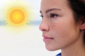 ÁNH NẮNG MẶT TRỜI - NGUYÊN NHÂN GÂY MỤN VÀ LÃO HÓA